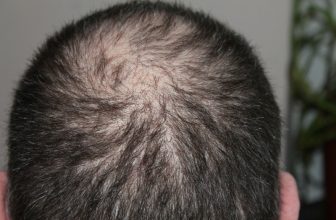 Le plasma enrichi en PRP est-il un traitement efficace contre la calvitie ? Quel prix ?